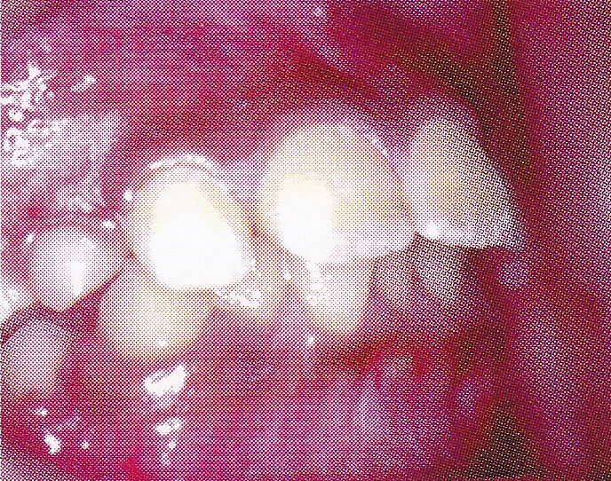 出っ歯の治療前