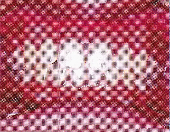 出っ歯の治療後