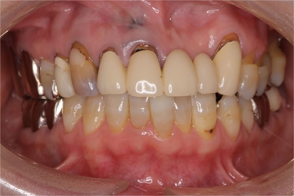 初診時の口腔内