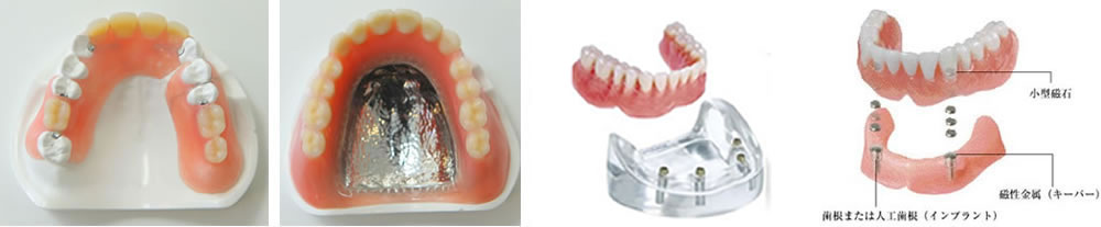 豊富な入れ歯素材