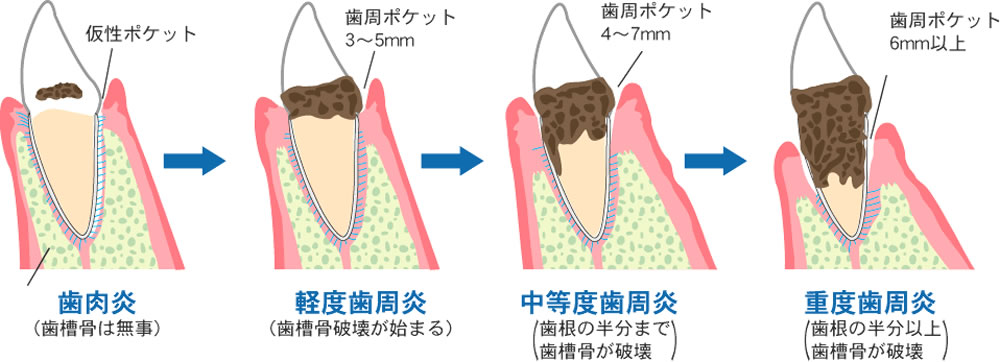 歯周病治療